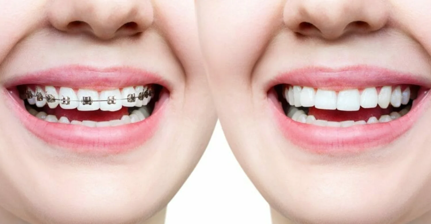 Whitening with braces at home 2